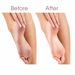 Electric Foot Callus Remover